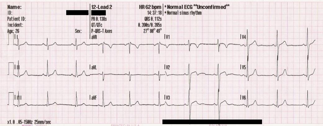 ECG tracing